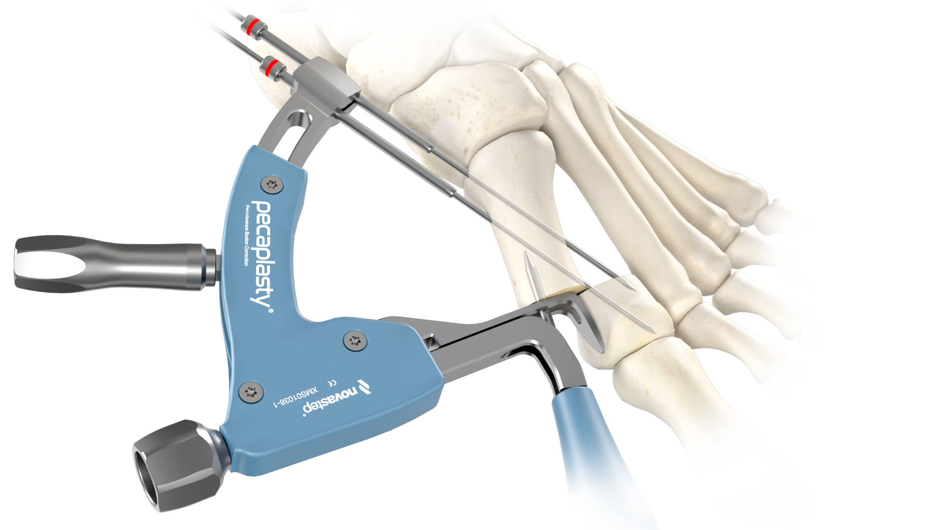 Novastep International | Foot & Ankle Surgery Solutions