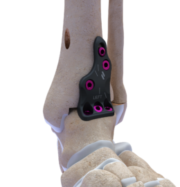 Novastep_airlock_ankle_extraction_image15_synthes3d_v1