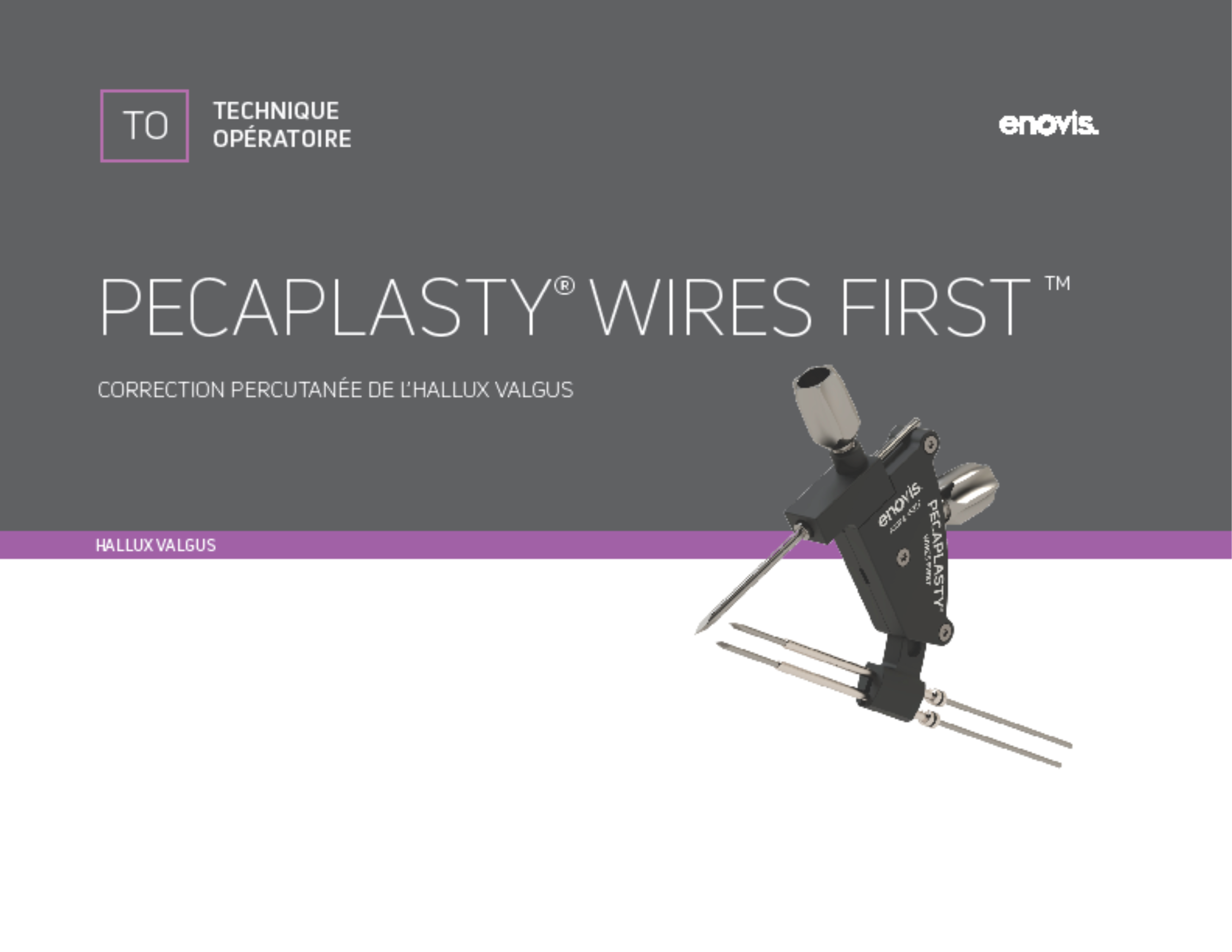 Pecaplasty® Wires FIrst Operative technique